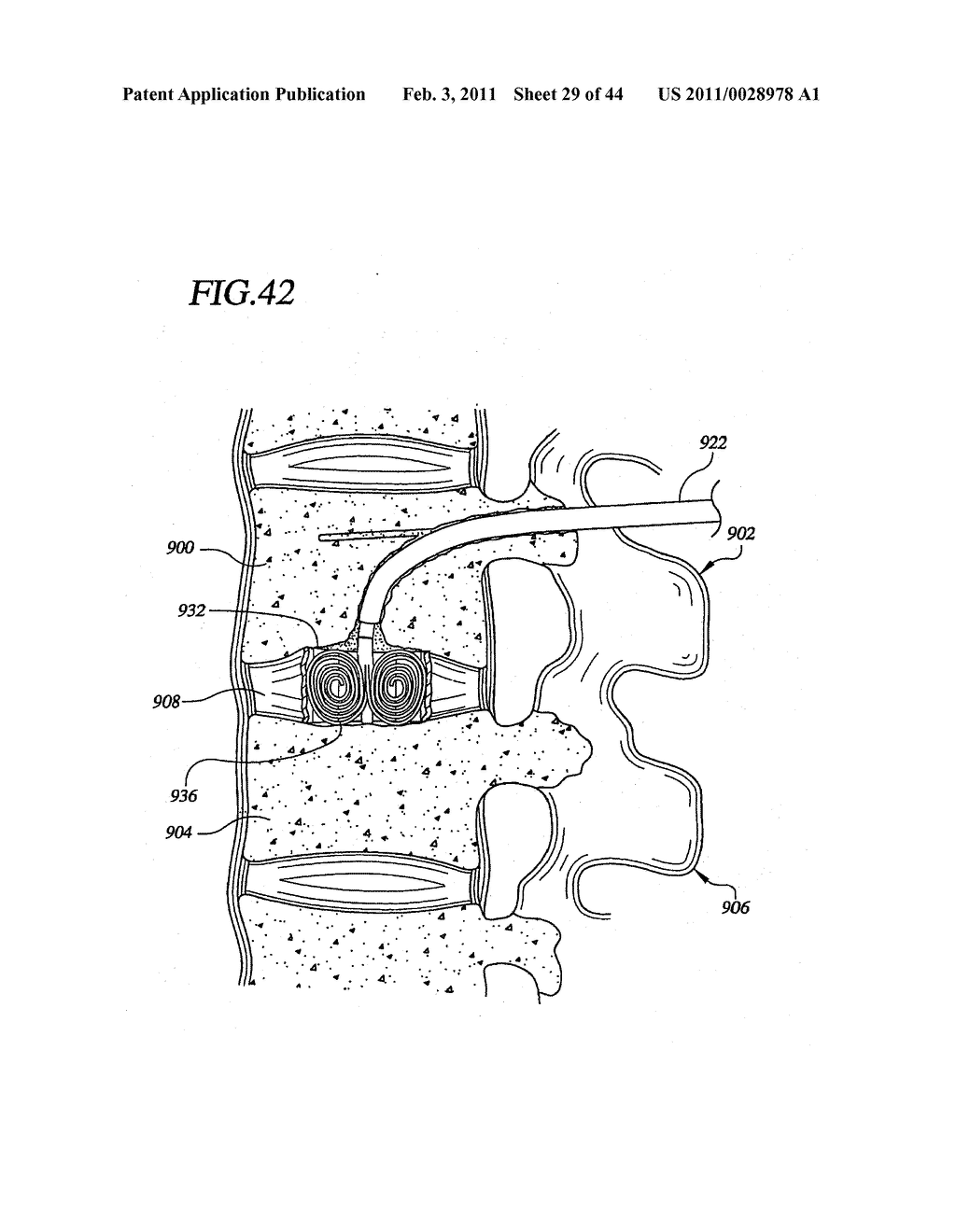 Transpedicular Intervertebral Disk Access Methods and Devices - diagram, schematic, and image 30