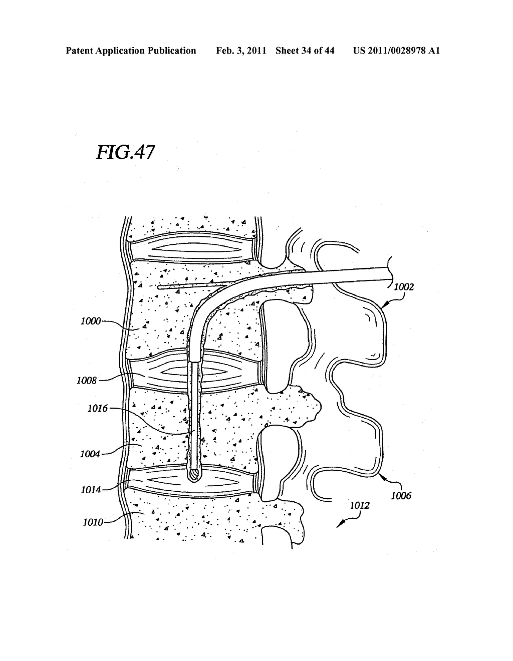 Transpedicular Intervertebral Disk Access Methods and Devices - diagram, schematic, and image 35