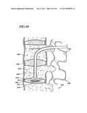 Transpedicular Intervertebral Disk Access Methods and Devices diagram and image