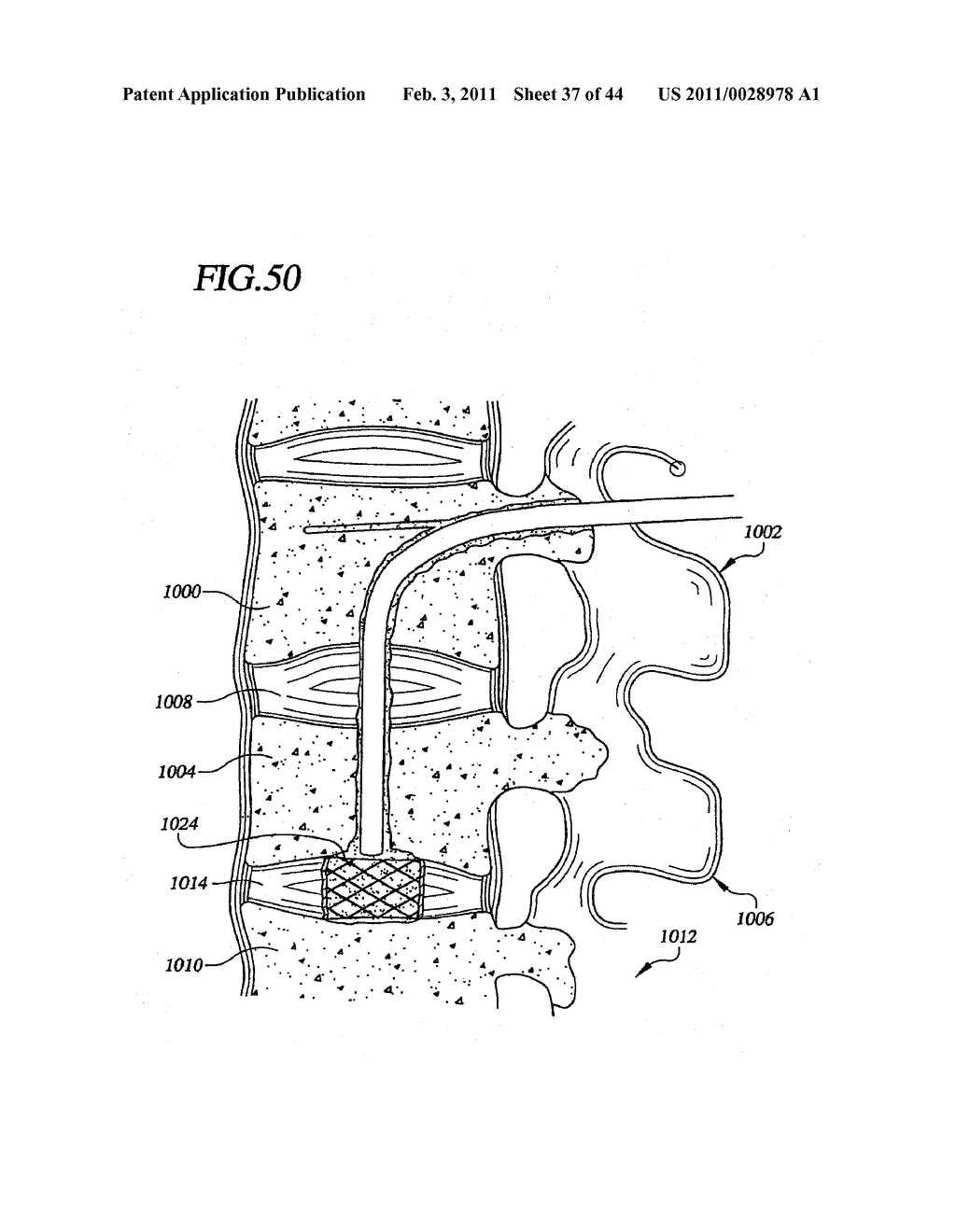 Transpedicular Intervertebral Disk Access Methods and Devices - diagram, schematic, and image 38