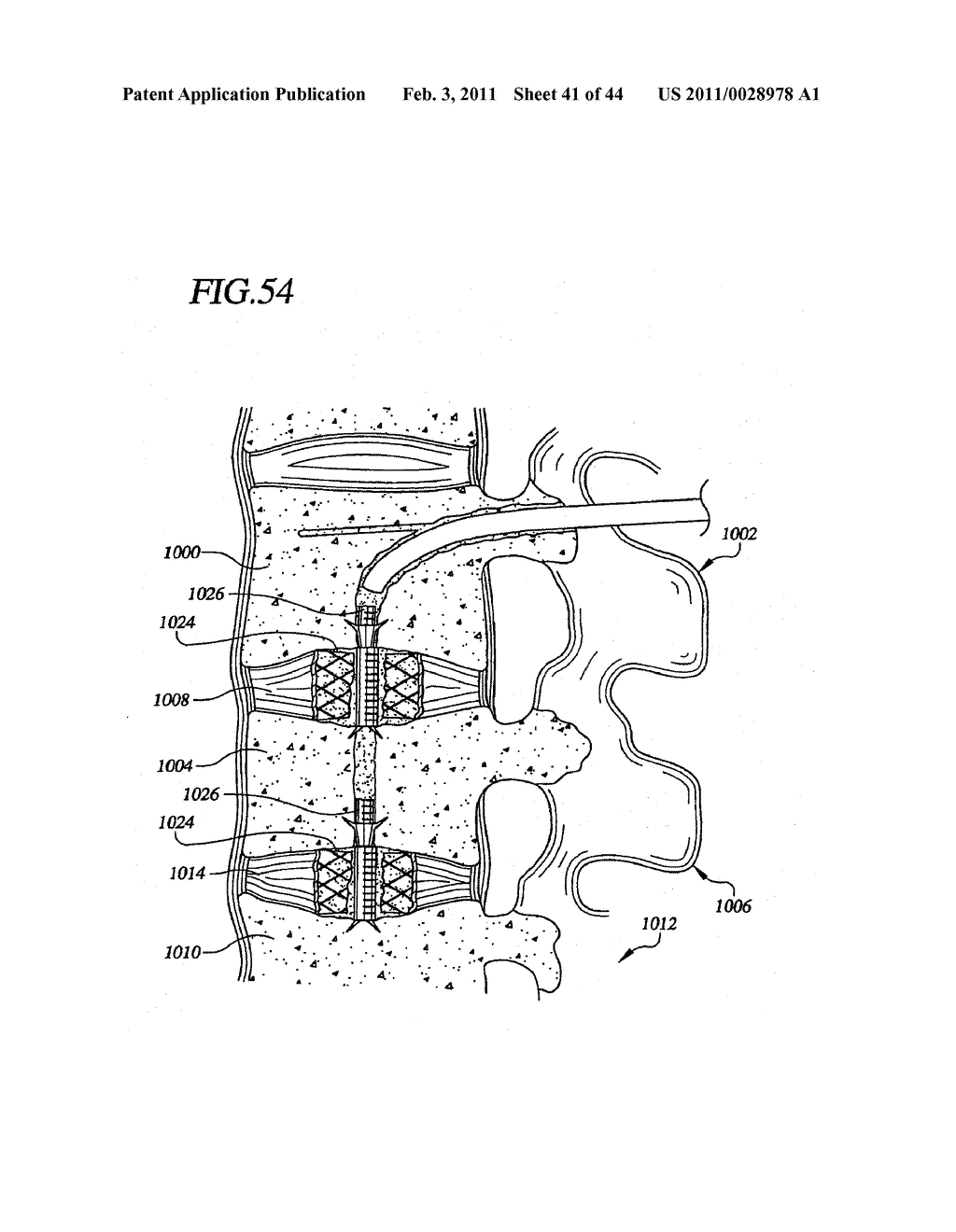 Transpedicular Intervertebral Disk Access Methods and Devices - diagram, schematic, and image 42