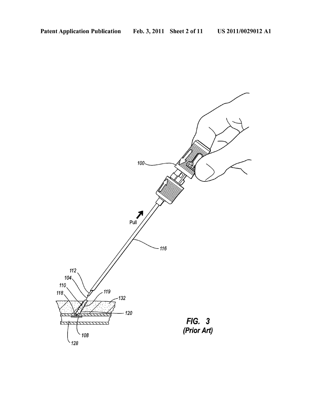DUAL HYPOTUBE SUTURE CUTTING DEVICE AND METHODS - diagram, schematic, and image 03