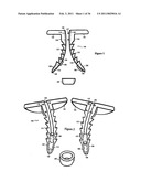 Elastic tissue closure with elastic staple diagram and image