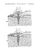 Elastic tissue closure with elastic staple diagram and image