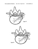 Elastic tissue closure with elastic staple diagram and image