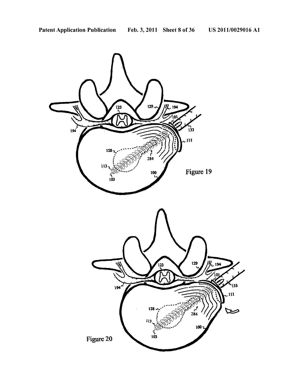 Elastic tissue closure with elastic staple - diagram, schematic, and image 09