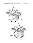 Elastic tissue closure with elastic staple diagram and image