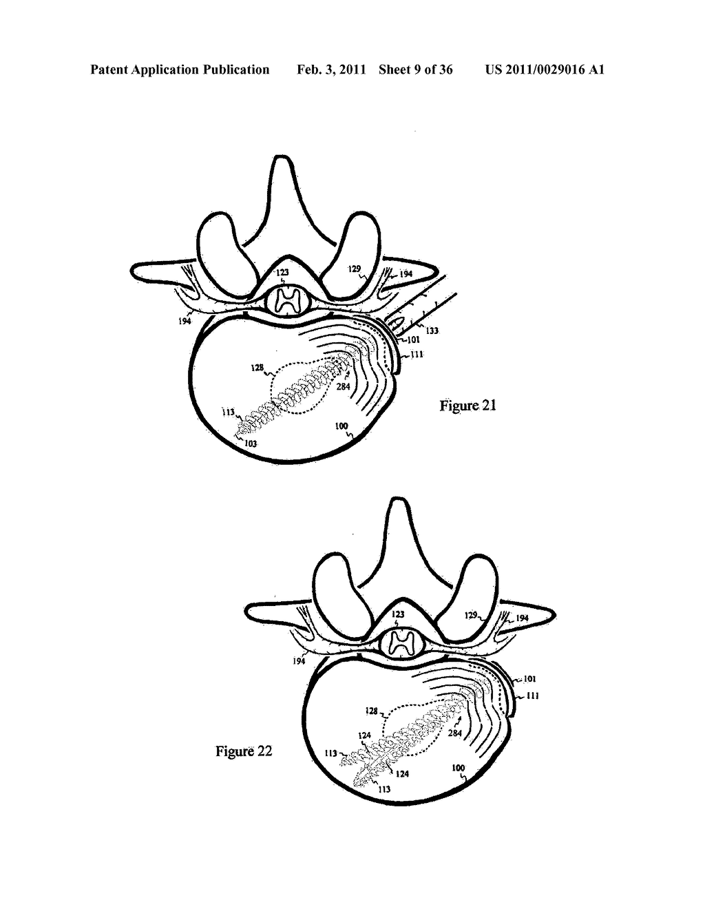 Elastic tissue closure with elastic staple - diagram, schematic, and image 10