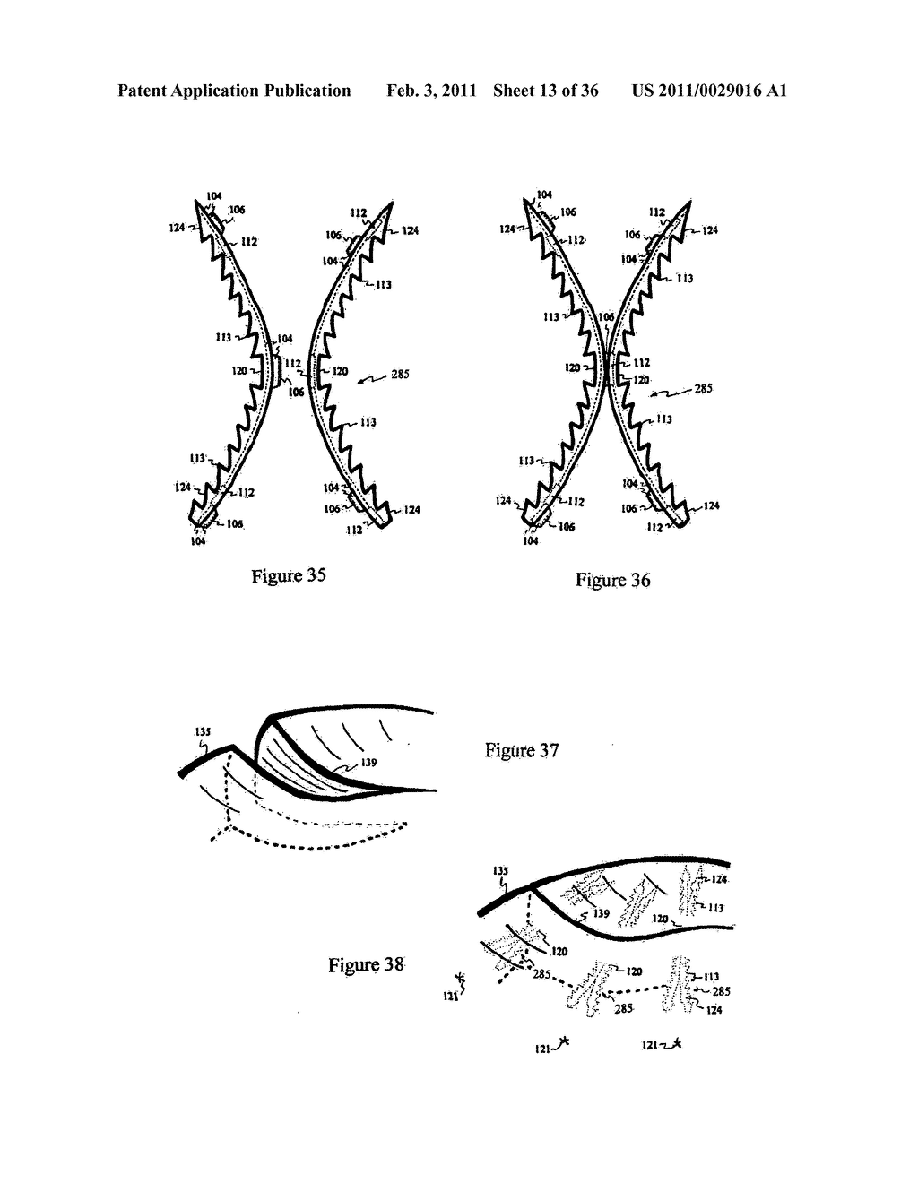 Elastic tissue closure with elastic staple - diagram, schematic, and image 14