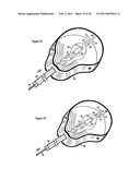 Elastic tissue closure with elastic staple diagram and image