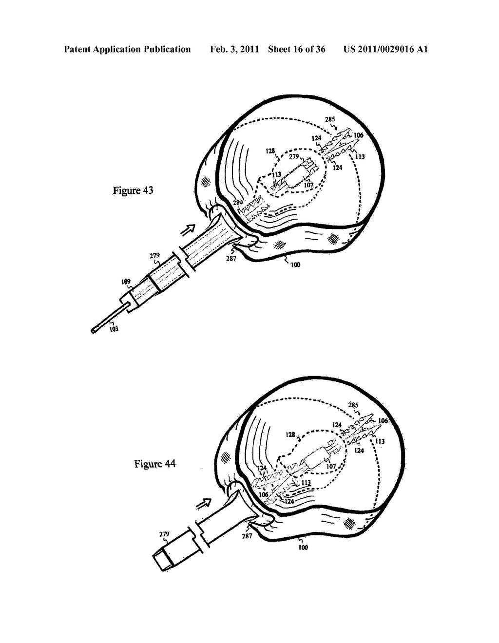 Elastic tissue closure with elastic staple - diagram, schematic, and image 17