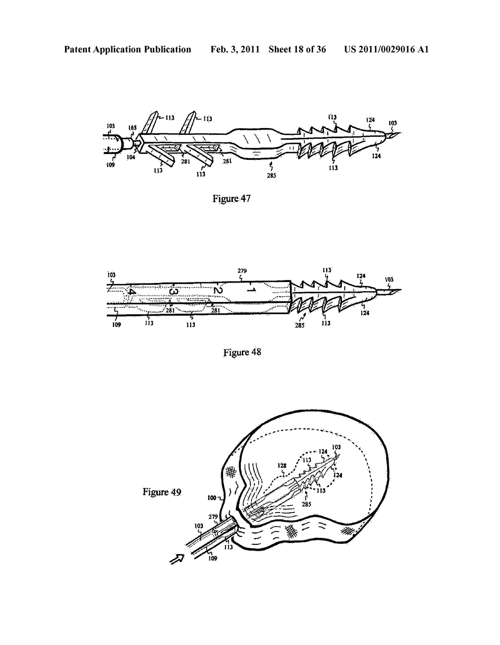 Elastic tissue closure with elastic staple - diagram, schematic, and image 19