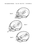 Elastic tissue closure with elastic staple diagram and image