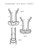 Elastic tissue closure with elastic staple diagram and image