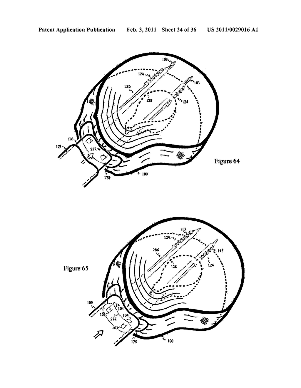 Elastic tissue closure with elastic staple - diagram, schematic, and image 25