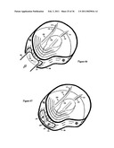 Elastic tissue closure with elastic staple diagram and image