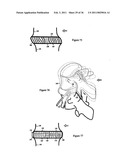 Elastic tissue closure with elastic staple diagram and image