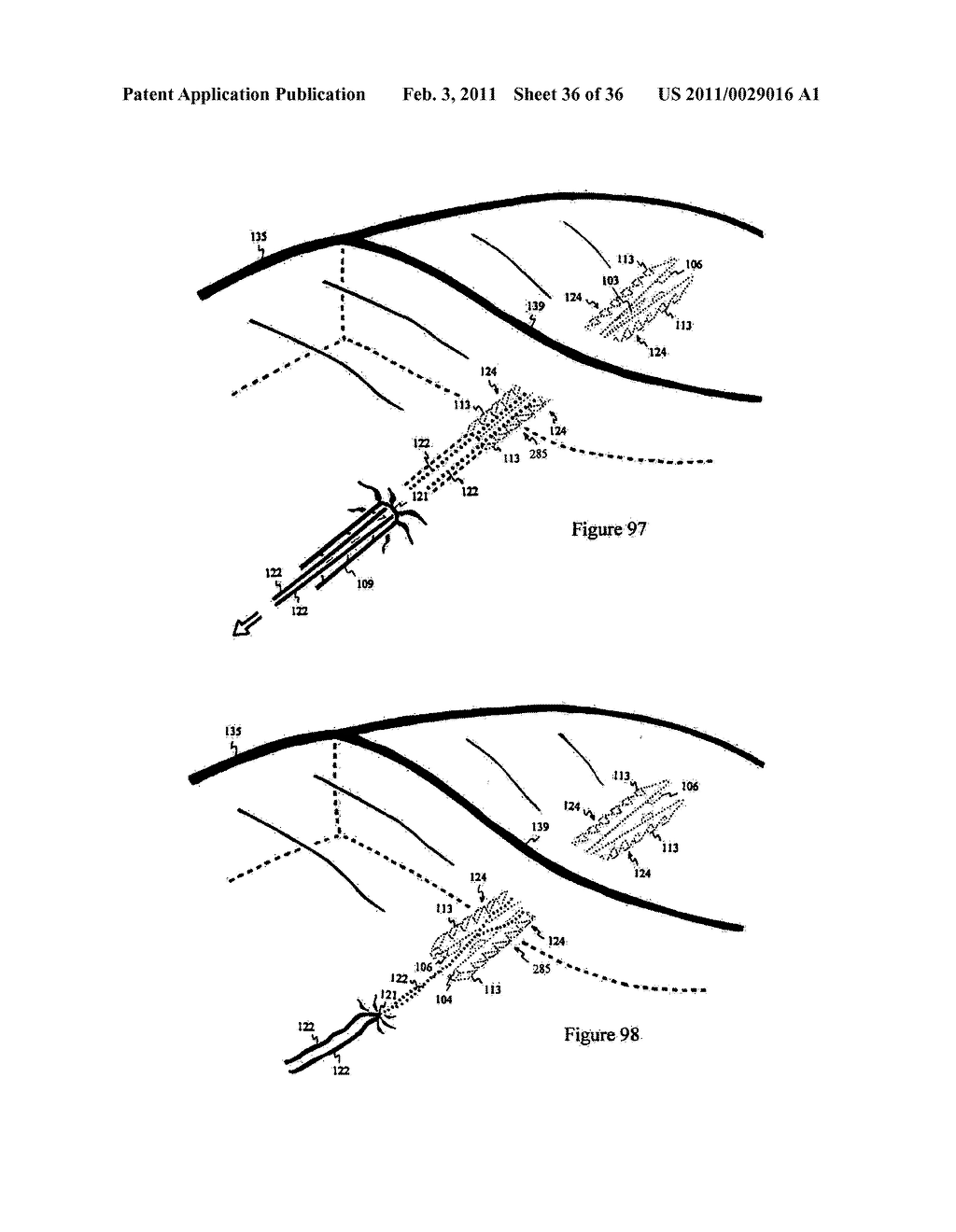 Elastic tissue closure with elastic staple - diagram, schematic, and image 37