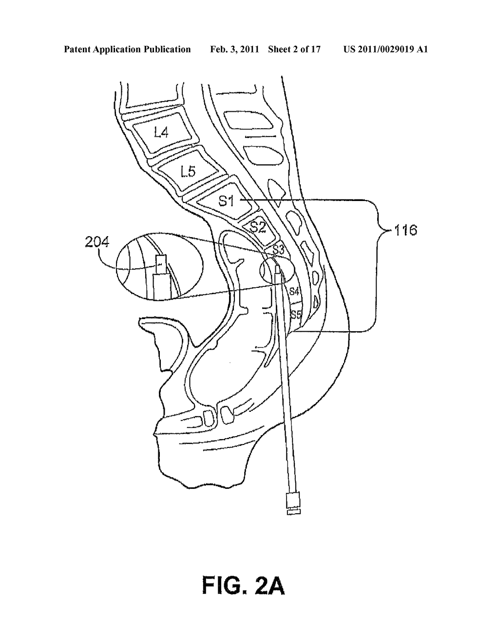 ASSEMBLIES FOR PROVISION OF THERAPY TO MOTION SEGMENTS - diagram, schematic, and image 03