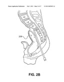 ASSEMBLIES FOR PROVISION OF THERAPY TO MOTION SEGMENTS diagram and image