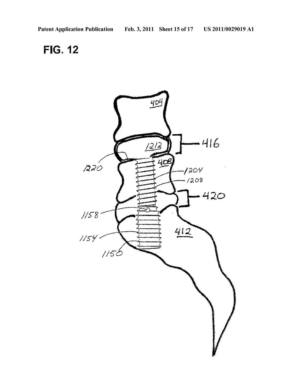 ASSEMBLIES FOR PROVISION OF THERAPY TO MOTION SEGMENTS - diagram, schematic, and image 16