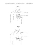 Cardioverter-Defibrillator Having a Focused Shocking Area and Orientation Thereof diagram and image