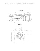 Cardioverter-Defibrillator Having a Focused Shocking Area and Orientation Thereof diagram and image