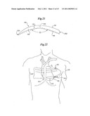 Cardioverter-Defibrillator Having a Focused Shocking Area and Orientation Thereof diagram and image