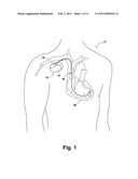 Co-Fired Electrical Feedthroughs for Implantable Medical Devices Having a Shielded RF Conductive Path and Impedance Matching diagram and image