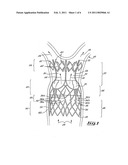 Stent valve and method of using same diagram and image