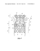 Stent valve and method of using same diagram and image