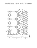 Stent valve and method of using same diagram and image