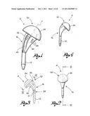 Shoulder Prosthesis diagram and image