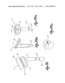 Shoulder Prosthesis diagram and image