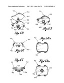 Shoulder Prosthesis diagram and image