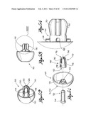 Shoulder Prosthesis diagram and image