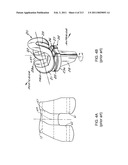 Patient-adapted and improved articular implants, designs and related guide tools diagram and image