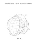 Patient-adapted and improved articular implants, designs and related guide tools diagram and image