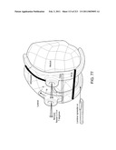 Patient-adapted and improved articular implants, designs and related guide tools diagram and image