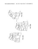 Patient-adapted and improved articular implants, designs and related guide tools diagram and image