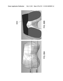 Patient-adapted and improved articular implants, designs and related guide tools diagram and image