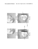 Patient-adapted and improved articular implants, designs and related guide tools diagram and image