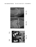 Patient-adapted and improved articular implants, designs and related guide tools diagram and image