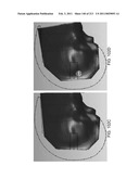 Patient-adapted and improved articular implants, designs and related guide tools diagram and image