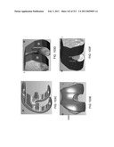 Patient-adapted and improved articular implants, designs and related guide tools diagram and image