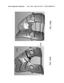 Patient-adapted and improved articular implants, designs and related guide tools diagram and image