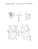 Patient-adapted and improved articular implants, designs and related guide tools diagram and image