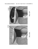 Patient-adapted and improved articular implants, designs and related guide tools diagram and image