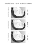 Patient-adapted and improved articular implants, designs and related guide tools diagram and image