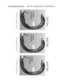 Patient-adapted and improved articular implants, designs and related guide tools diagram and image